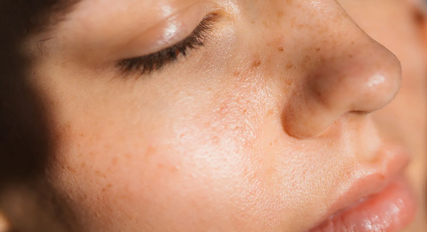 5 Beauty Hacks to Minimize Enlarged Skin Pores for Smooth, Clear Skin